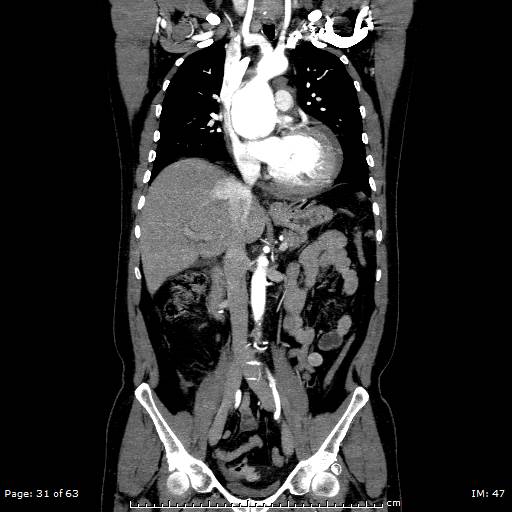File:Ascending aortic aneurysm (Radiopaedia 50086-55404 B 31).jpg
