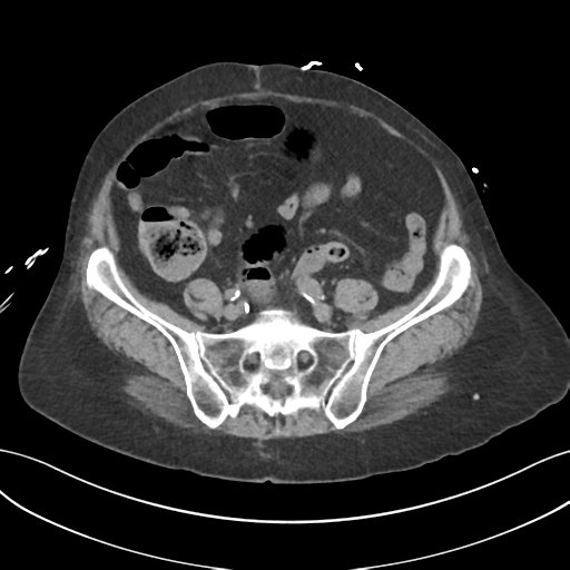File:Ascending cholangitis (Radiopaedia 39068-41253 Axial non-contrast 46).png