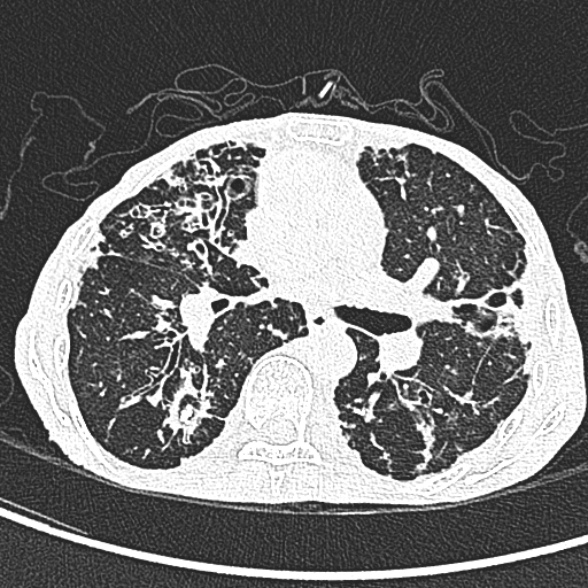 Aspergilloma- with Monod sign (Radiopaedia 44737-48532 Axial lung window 129).jpg