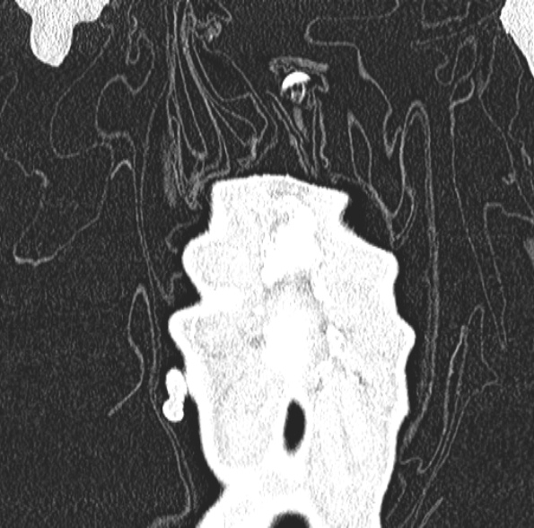 Aspergilloma- with Monod sign (Radiopaedia 44737-48532 Coronal lung window 108).jpg
