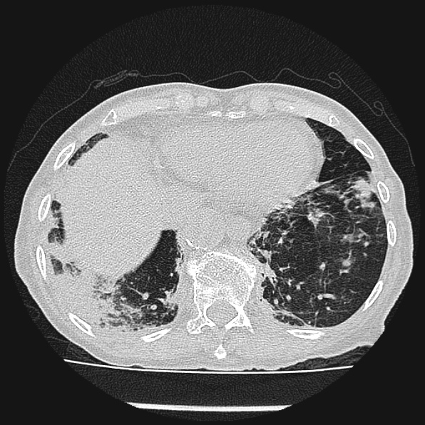 Aspergilloma (Radiopaedia 24458-24763 Axial lung window 56).jpg