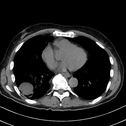 Aspergilloma on background pulmonary fibrosis (Radiopaedia 60942-68757 Axial non-contrast 38).jpg