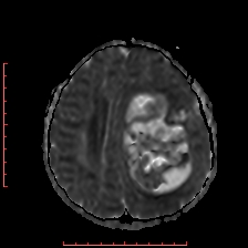 File:Astroblastoma (Radiopaedia 74287-85162 Axial ADC 44).jpg