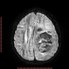 Astroblastoma (Radiopaedia 74287-85162 Axial DWI 68).jpg