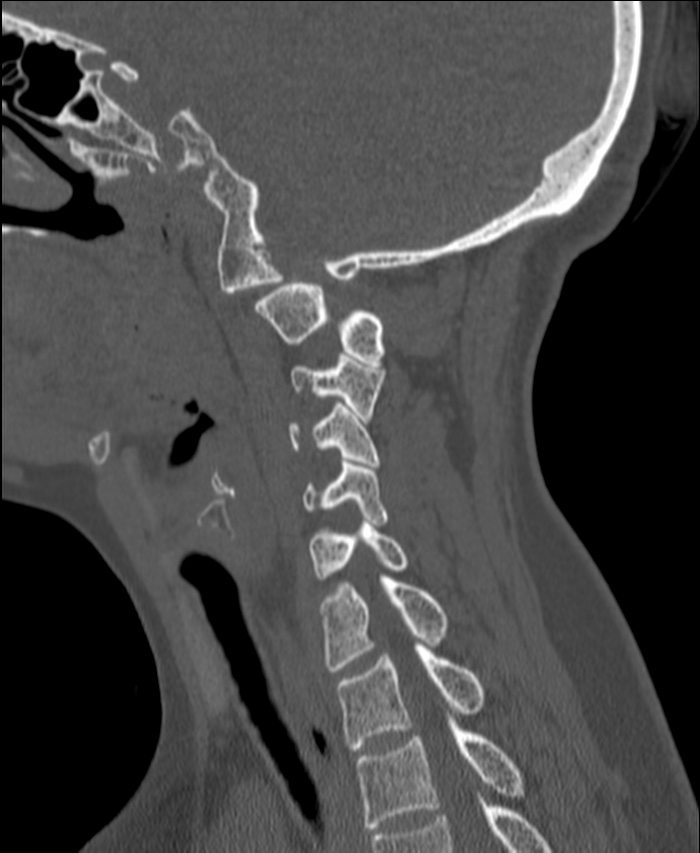 Atlanto-occipital assimilation with basilar invagination (Radiopaedia 70122-80188 Sagittal bone window 96).jpg