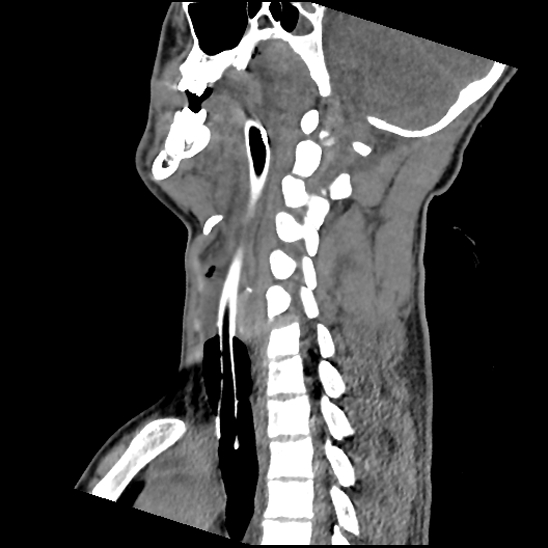 Atlanto-occipital dissociation (Traynelis type 1), C2 teardrop fracture, C6-7 facet joint dislocation (Radiopaedia 87655-104061 D 42).jpg
