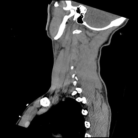 Atlanto-occipital dissociation (Traynelis type 1), C2 teardrop fracture, C6-7 facet joint dislocation (Radiopaedia 87655-104061 D 63).jpg