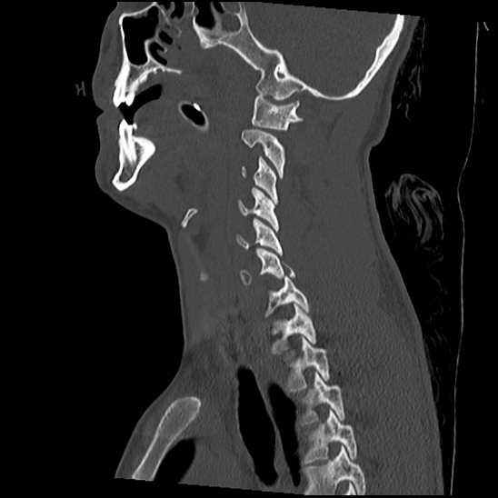Atlanto-occipital dissociation (Traynelis type 1), C2 teardrop fracture, C6-7 facet joint dislocation (Radiopaedia 87655-104061 Sagittal bone window 28).jpg