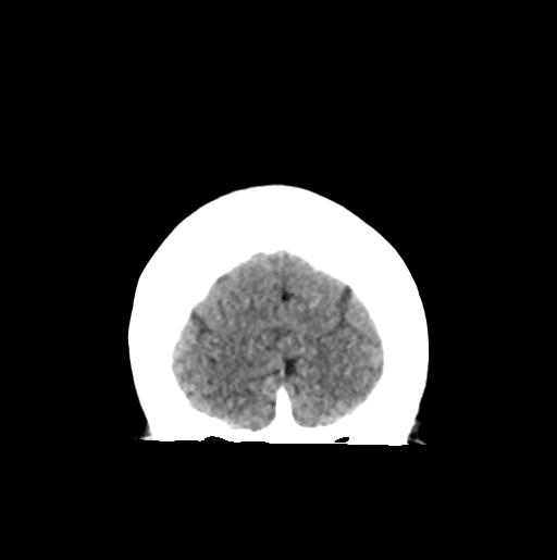 File:Atretic encephalocoele with inferior vermis hypoplasia (Radiopaedia 30443-31107 Coronal non-contrast 6).jpg