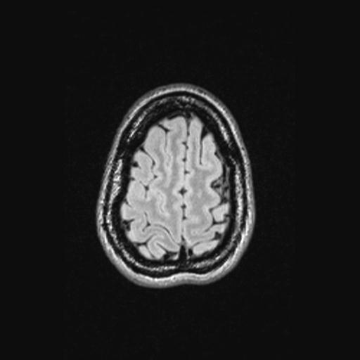 Atretic encephalocoele with inferior vermis hypoplasia (Radiopaedia 30443-31108 Axial 135).jpg