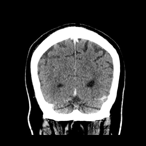Atypical meningioma (WHO grade II) with brain invasion (Radiopaedia 57767-64728 Coronal C+ 52).png