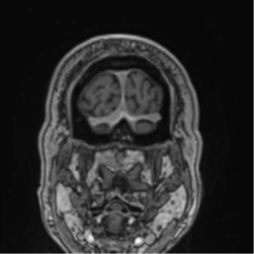 Atypical meningioma (WHO grade II) with brain invasion (Radiopaedia 57767-64729 Coronal T1 C+ 79).png