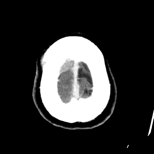 File:Atypical meningioma (WHO grade II) with osseous invasion (Radiopaedia 53654-59715 Axial C+ delayed 48).png