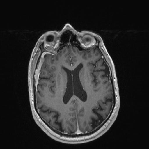 Atypical meningioma (grade II) - en plaque (Radiopaedia 29633-30147 Axial T1 C+ 117).jpg