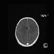 Atypical teratoid rhabdoid tumor (prenatal US and neonatal MRI) (Radiopaedia 59091-66388 Axial T1 C+ 47).jpg