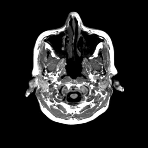 Autoimmune limbic encephalitis (Radiopaedia 30363-31005 T1 Axial 1mm 13).jpg