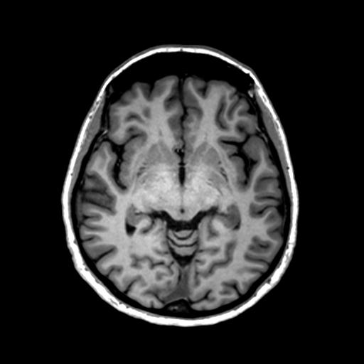 Autoimmune limbic encephalitis (Radiopaedia 30363-31005 T1 Axial 1mm 70).jpg