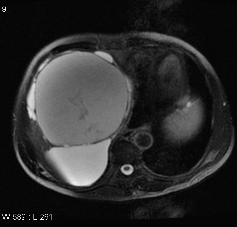 File:Autosomal dominant polycystic kidney disease (Radiopaedia 5202-6969 Axial T2 fat sat 2).jpg