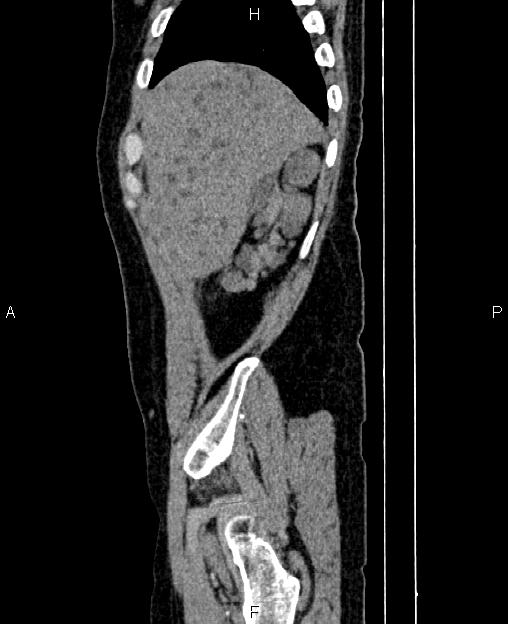 Autosomal dominant polycystic kidney disease (Radiopaedia 87830-104287 C 8).jpg