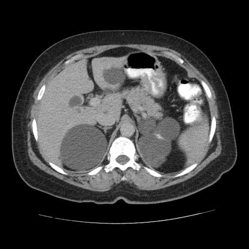 File:Autosomal dominant polycystic kidney disease with hepatic involvement (Radiopaedia 32693-33662 C 20).jpg