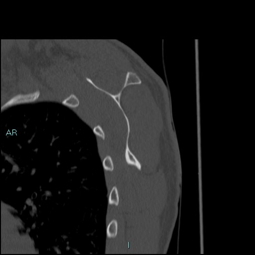 Avascular necrosis after fracture dislocations of the proximal humerus (Radiopaedia 88078-104653 Sagittal bone window 60).jpg