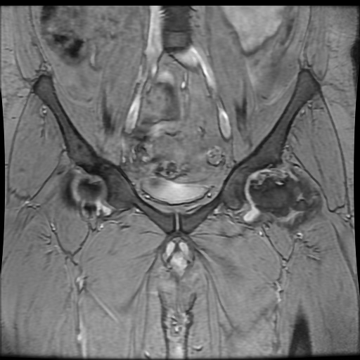 Avascular necrosis of the hip (Radiopaedia 61503-69465 F 29).jpg