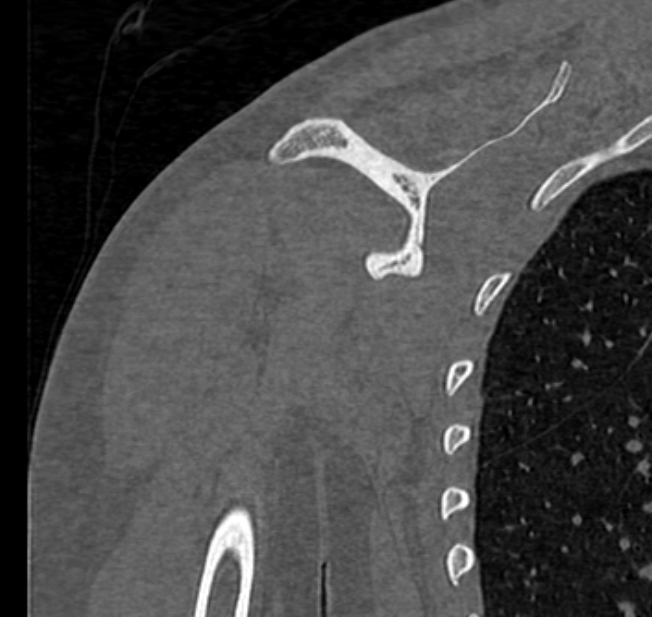 Avulsion fracture - greater tuberosity of humerus (Radiopaedia 71216-81514 Coronal bone window 48).jpg