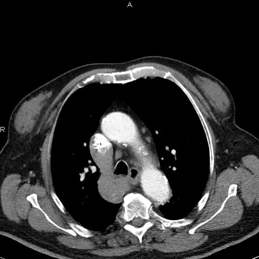 File:Azygos continuation of the inferior vena cava (Radiopaedia 18537-18404 C+ arterial phase 21).jpg
