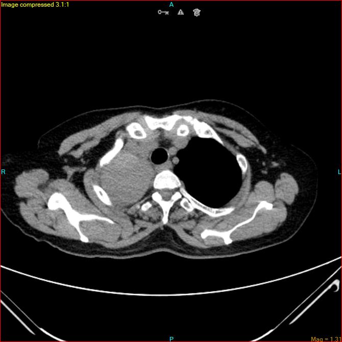 Azygos vein aneurysm (Radiopaedia 77824-90130 A 12).jpg