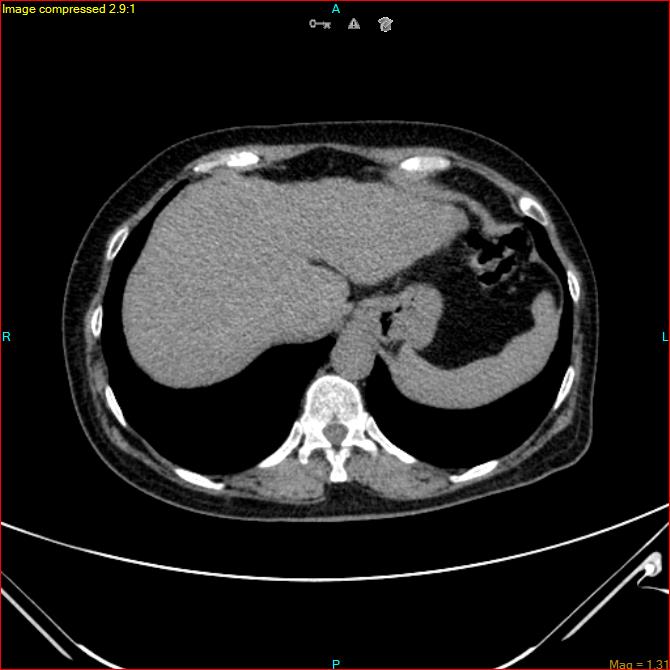 Azygos vein aneurysm (Radiopaedia 77824-90130 A 47).jpg