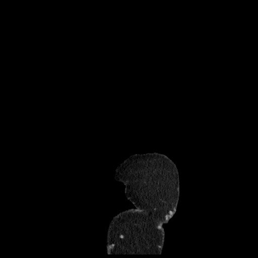 B-cell lymphoma of the mesentery (Radiopaedia 65711-74827 C 10).jpg