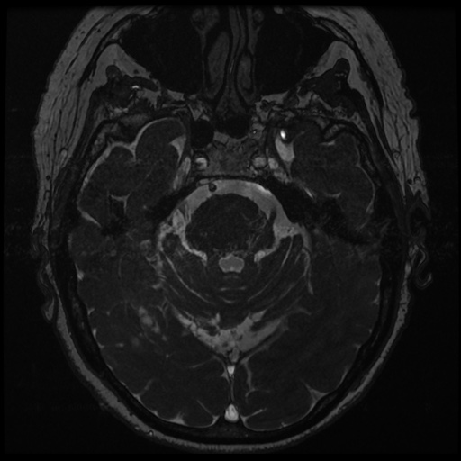 File:Balo concentric sclerosis (Radiopaedia 53875-59982 Axial T2 FIESTA 55).jpg