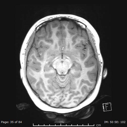 Balo concentric sclerosis (Radiopaedia 61637-69636 Axial T1 35).jpg