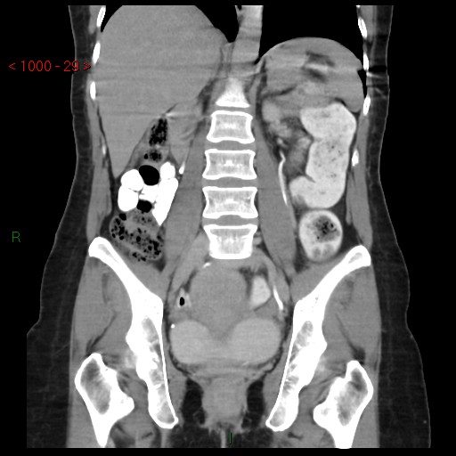 File:Bartholin gland cyst (Radiopaedia 54904-61181 Coronal C+ delayed 29).jpg