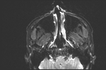 File:Basal cell carcinoma - nasal region (Radiopaedia 70292-80365 Axial DWI 16).jpg