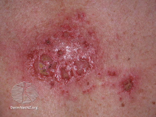 File:Basal cell carcinoma affecting the trunk (DermNet NZ lesions-bcc-trunk-0809).jpg