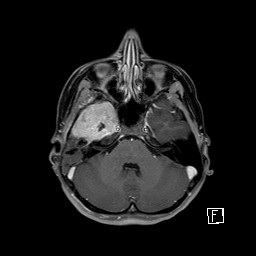 Base of skull rhabdomyosarcoma (Radiopaedia 32196-33142 T1 C+ fat sat 31).jpg