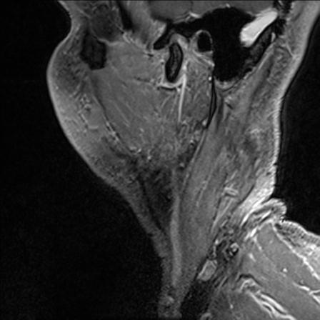 Base of tongue squamous cell carcinoma (Radiopaedia 31174-31884 F 157).jpg