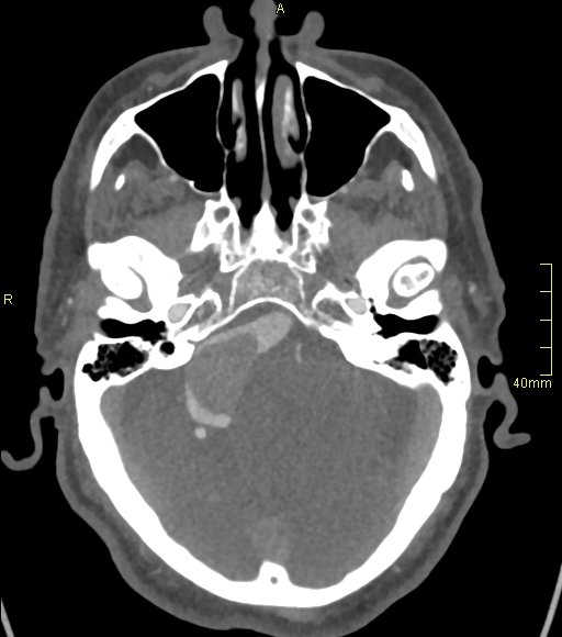 Basilar artery aneurysm (Radiopaedia 56261-62932 A 52).jpg