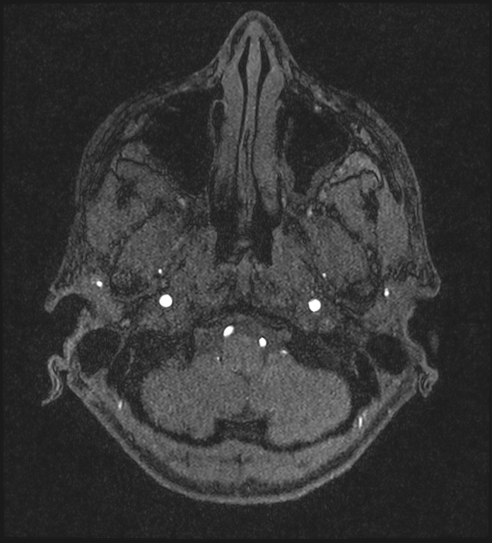 Basilar artery perforator aneurysm (Radiopaedia 82455-97733 Axial MRA 30).jpg