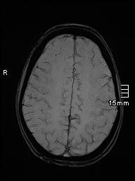 File:Basilar artery perforator aneurysm (Radiopaedia 82455-99523 Axial SWI 48).jpg