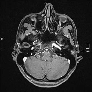 Basilar artery perforator aneurysm (Radiopaedia 82455-99523 G 20).jpg