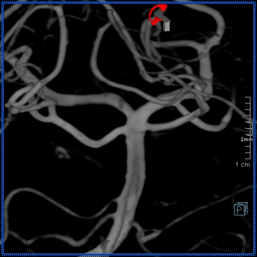 Basilar artery perforator aneurysm (Radiopaedia 82455-99524 3D Left VA 83).jpg