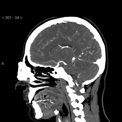 Basilar artery thrombosis (Radiopaedia 16260-15944 C 28).jpg