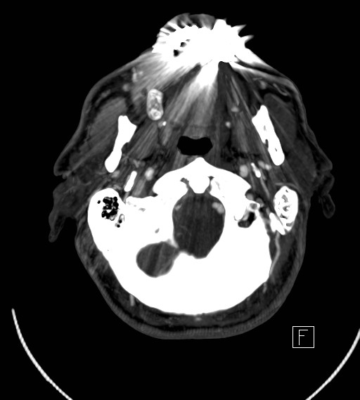 Basilar artery thrombosis (Radiopaedia 26986-27163 A 11).jpg