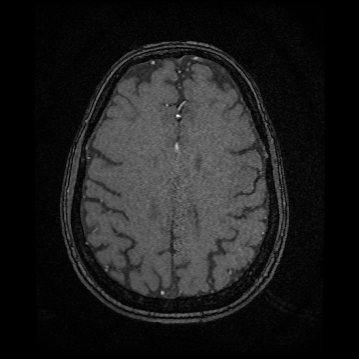 Basilar top and left middle cerebral artery aneurysm (Radiopaedia 61965-70031 Axial MRA 123).jpg