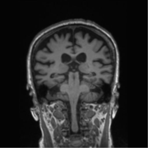 Behavioral variant frontotemporal dementia and late onset schizophrenia (Radiopaedia 52197-58083 Coronal T1 41).png