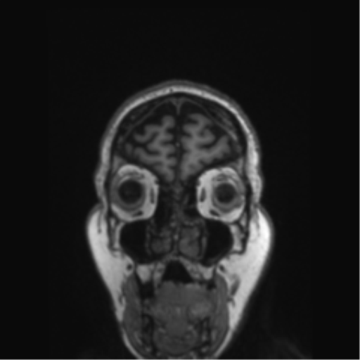 Behavioral variant frontotemporal dementia and late onset schizophrenia (Radiopaedia 52197-58083 Coronal T1 80).png