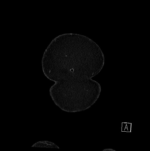 Below filter IVC thrombosis (Radiopaedia 58187-65266 B 11).jpg