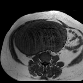 File:Benign seromucinous cystadenoma of the ovary (Radiopaedia 71065-81300 Axial T1 22).jpg